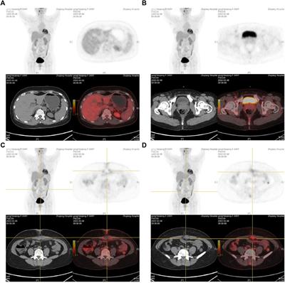 Urachus adenocarcinoma mistaken for umbilical incision implant cancer after laparoscopic cholecystectomy: a case report